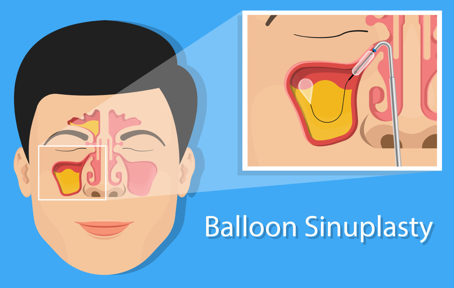 Here S What You Need To Know About The Balloon Sinuplasty System Berwyn